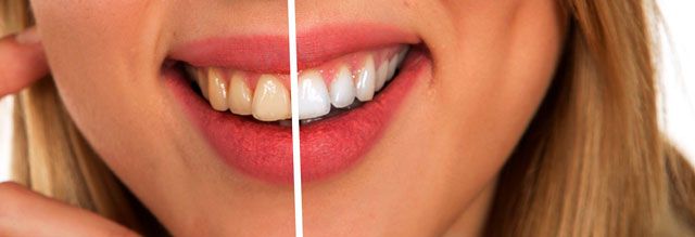 Dientes emblanquecidos.